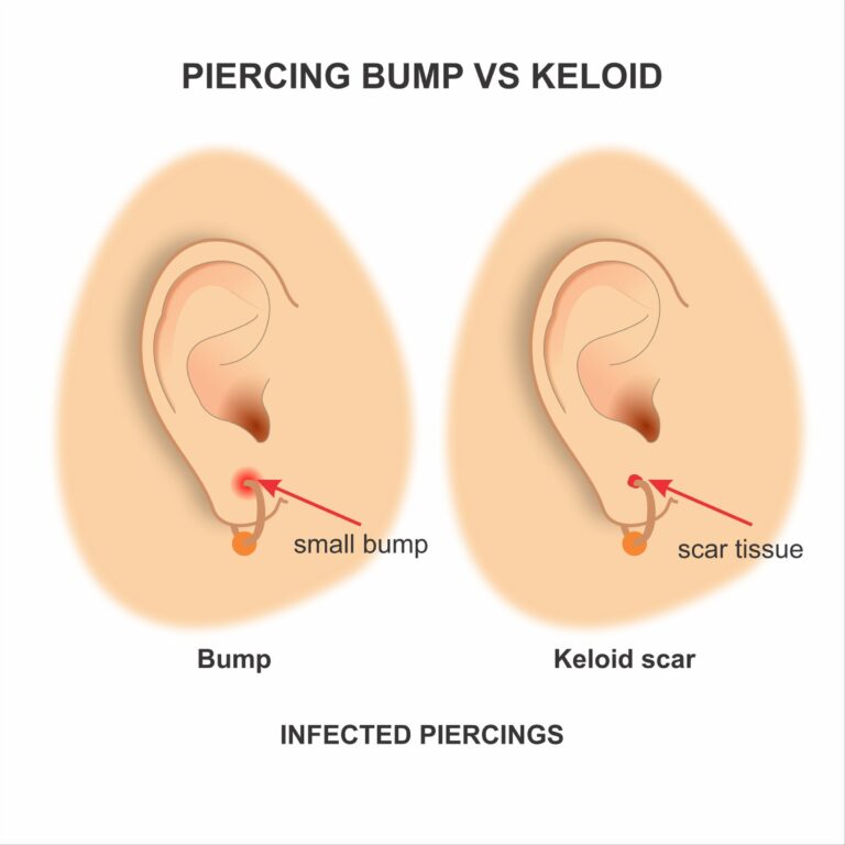 Piercing bump vs. Keloid
