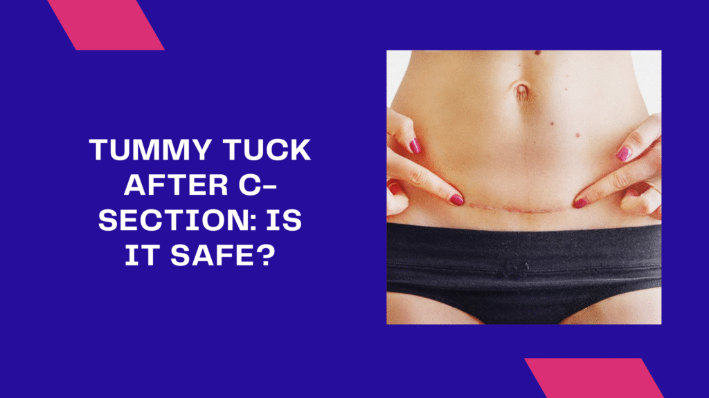 Tummy tuck after C-section